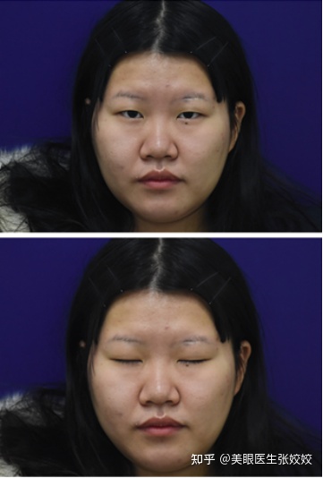 胖妹妹适合割双眼皮吗,胖女孩割双眼皮