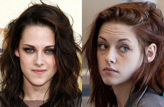 什么原因引起川字纹,如何消除川字纹最有效的方法