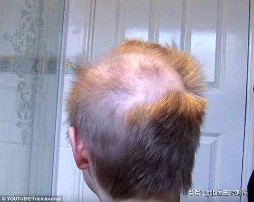 怎么分辨脱发的类型,脱发原因有几种类型