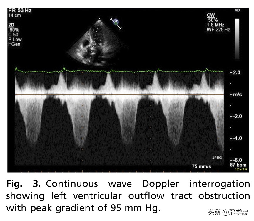 应激性心肌病搭桥,应激性心肌病反复