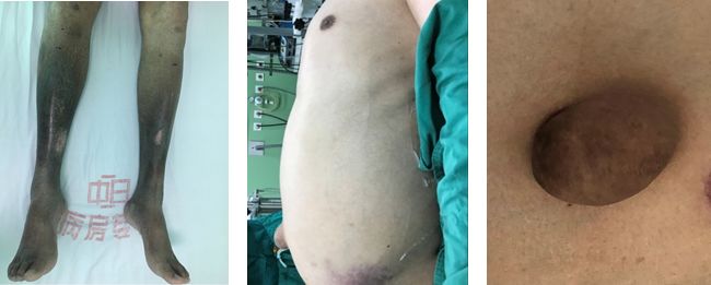 肺动脉血栓栓塞引起的肺高压,慢性血栓性肺动脉高压吃什么中药