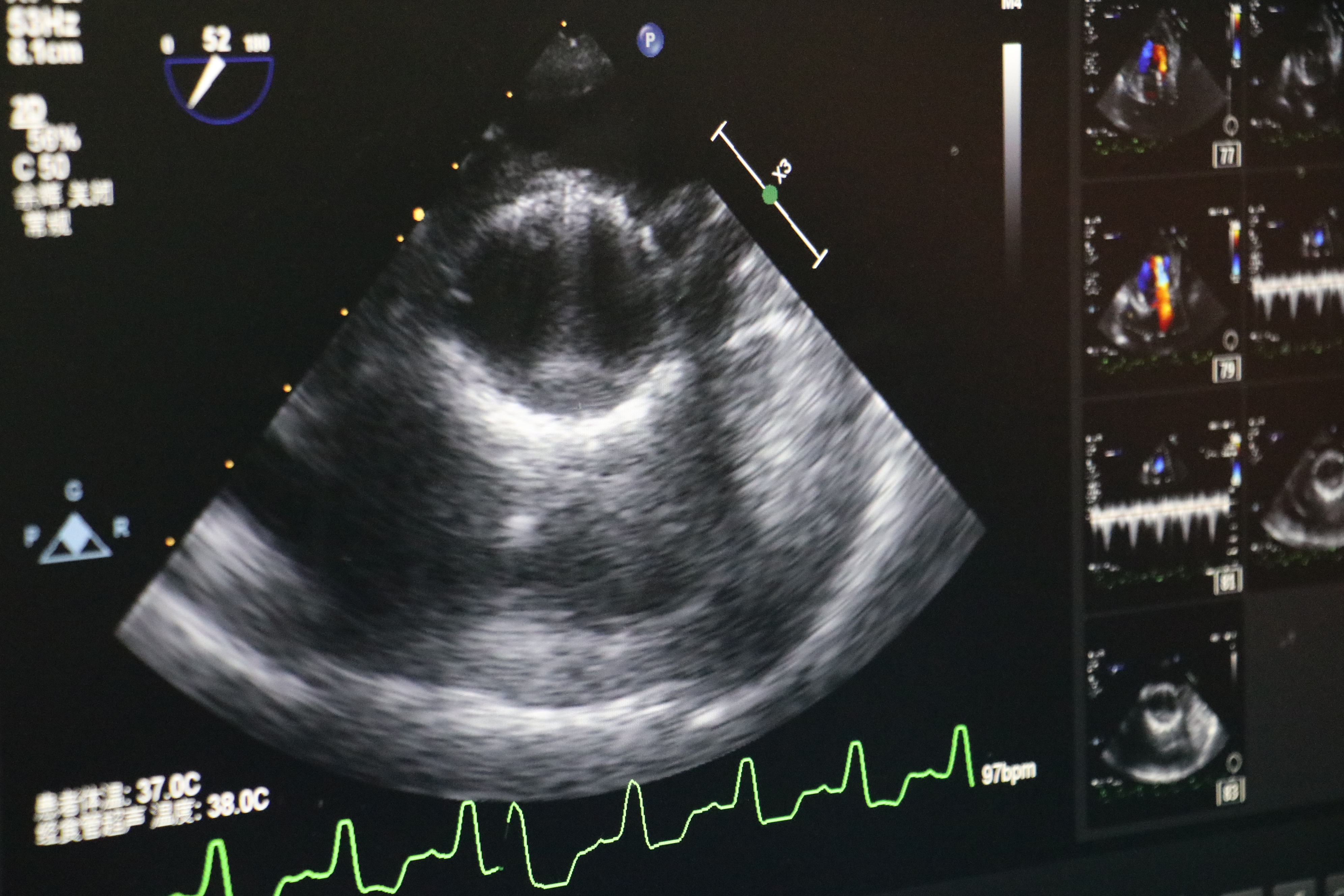 心脏病冠心病心血管疾病,冠心病心脏瓣膜病算是大病吗