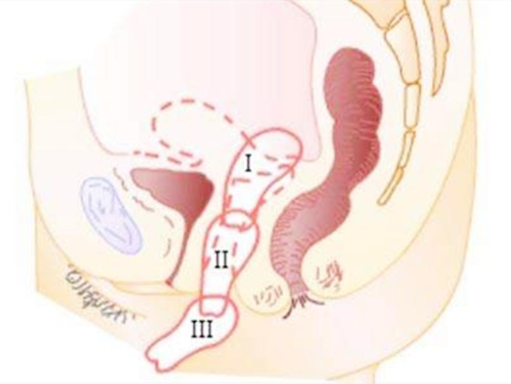 顺产8天排出一条异物正常不,孕早期宫缩腹痛排出异物