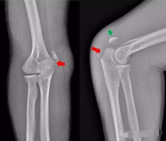 怎样发现骨折的可能性,一招看出手指骨折