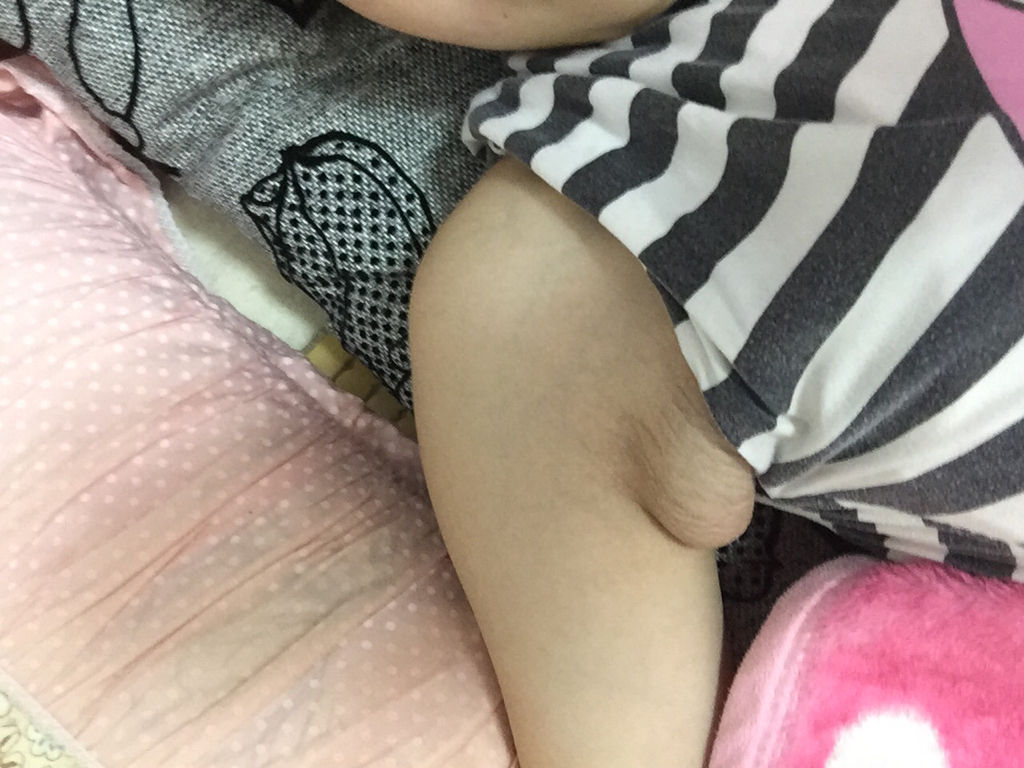 副乳里面有硬块要切除吗,副乳在腋窝下存在什么风险