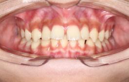 8岁的孩子能做牙齿矫正吗,7岁孩子矫正牙齿早吗