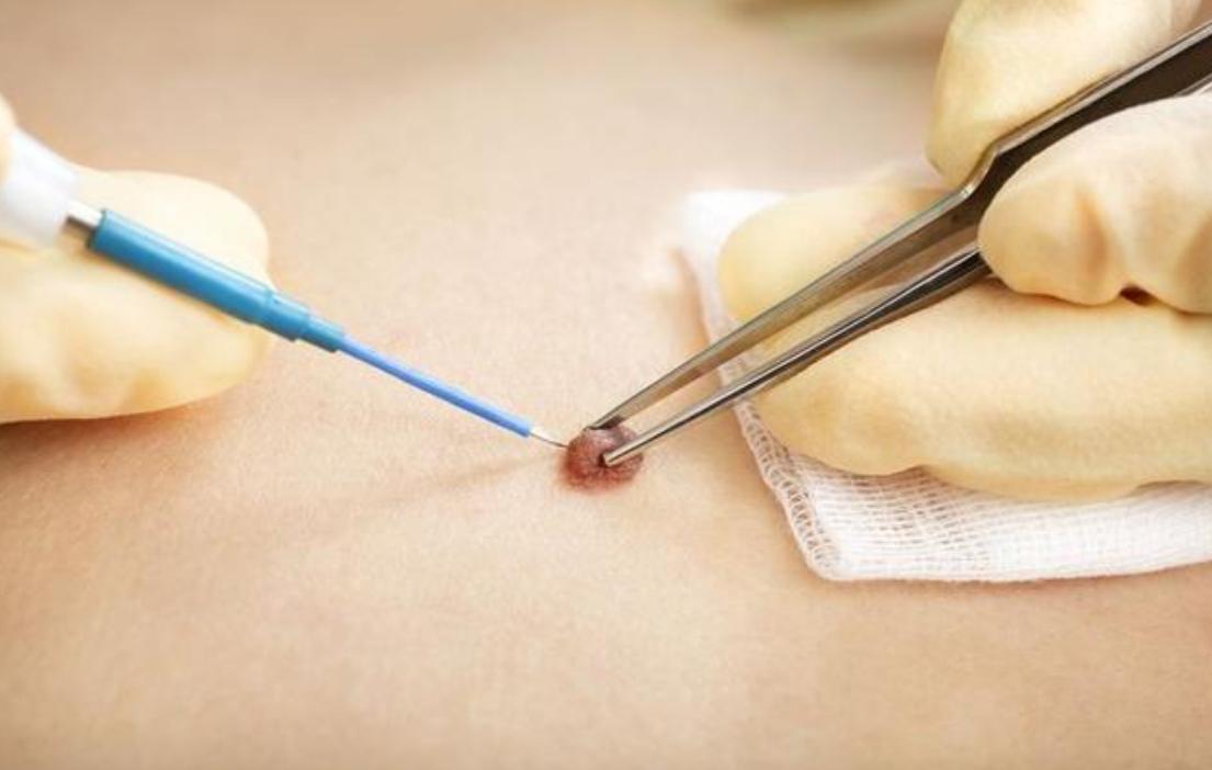 身上的痣自己会消除吗,身上的痣能随便去掉会死吗