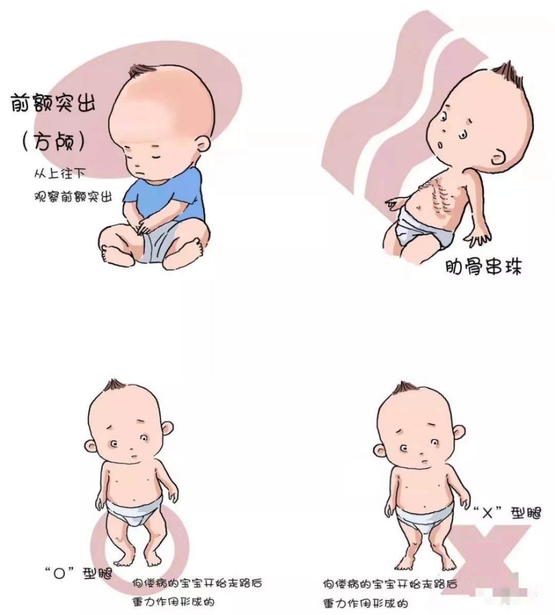 婴儿严重缺乏维生素d怎么办,宝宝维生素d缺乏有什么表现