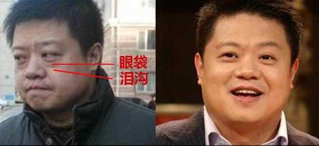 黑眼圈最快消除方法不用愁,黑眼圈去除最有效的方法推荐