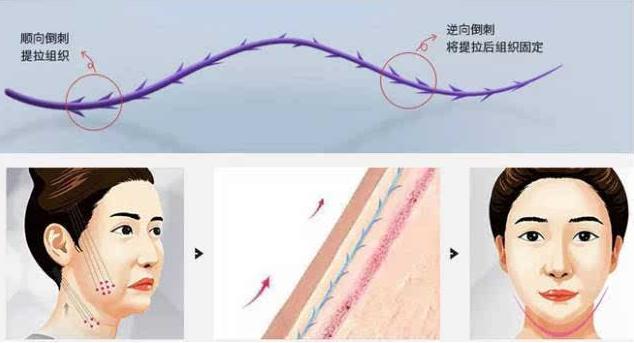 鼻唇沟苹果肌下垂怎么做,苹果肌下垂鼻基底凹陷做什么项目
