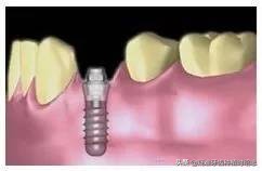 想种植牙牙槽骨骨量不足怎么办,骨量不足种植牙最新技术