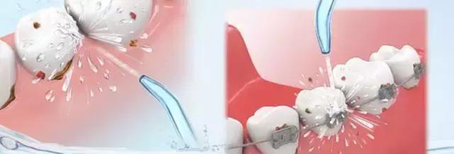 牙签不靠谱，谁才是真正的护牙神器？