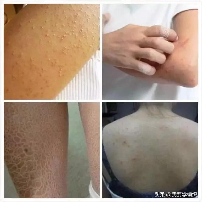 冬天干燥皮肤蛇皮,冬天冷皮肤粗糙