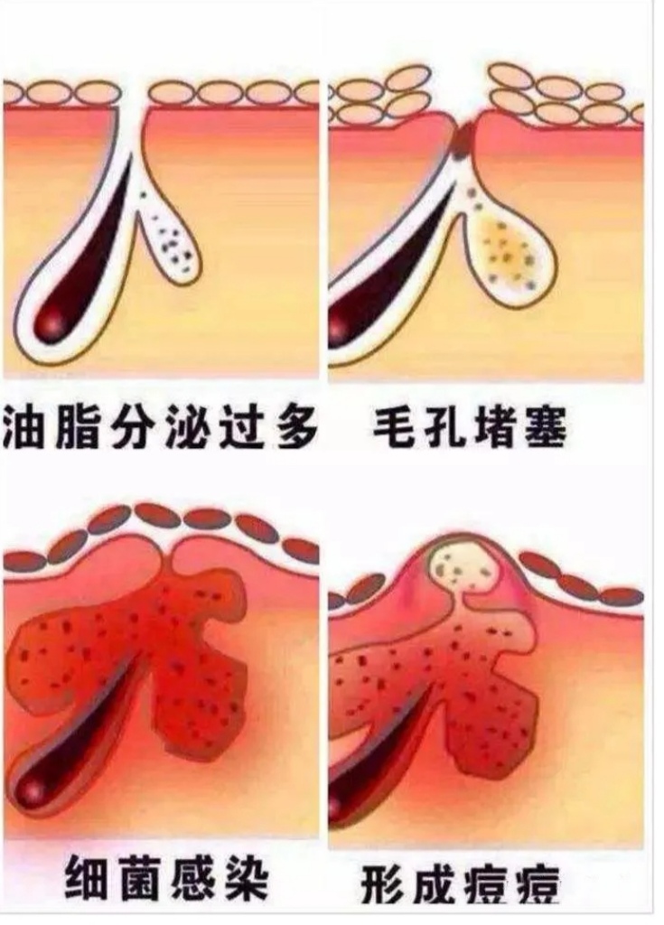皮脂腺怎么处理,皮脂腺大怎么办
