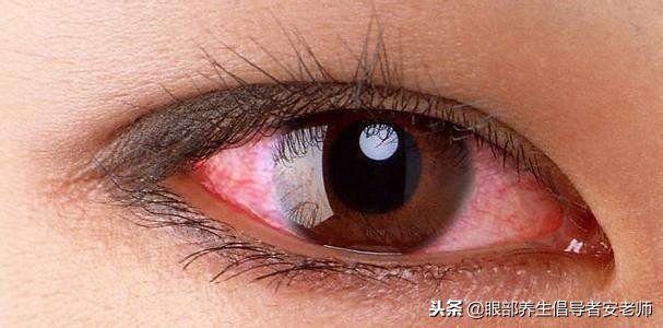 角膜炎眼睛发红用什么眼药水,戴隐形眼镜后眼睛红血丝正常吗