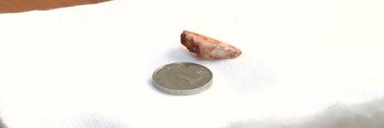 儿童被鸡抓伤长出鸡脚,小孩被鸡抓伤会留疤吗