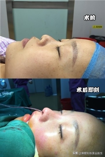 幼儿园鼻子扁平塌图片,如何矫正鼻子扁塌