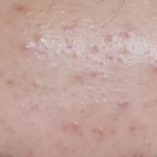 激光祛痣怎么好得快不留疤,激光祛痣亲身经历和感受