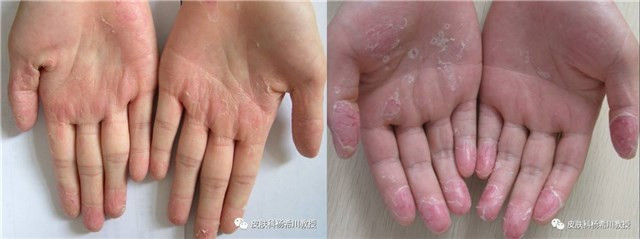 手脚掌脱皮,小孩手总脱皮的原因