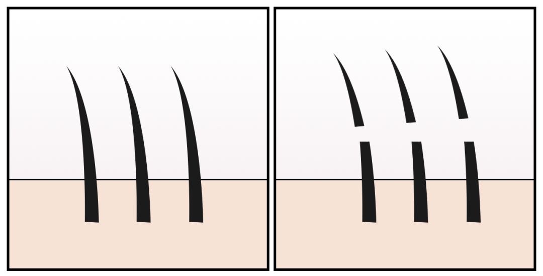 体毛脱毛的效果怎么样,天生体毛旺盛的人正常吗