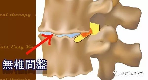 72岁老人腰疼还有骨刺该怎么治疗,老年人骨刺疼痛怎么治疗