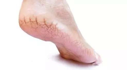 脚后跟干裂像鱼鳞是什么原因,脚后跟鱼鳞状干裂怎么刮