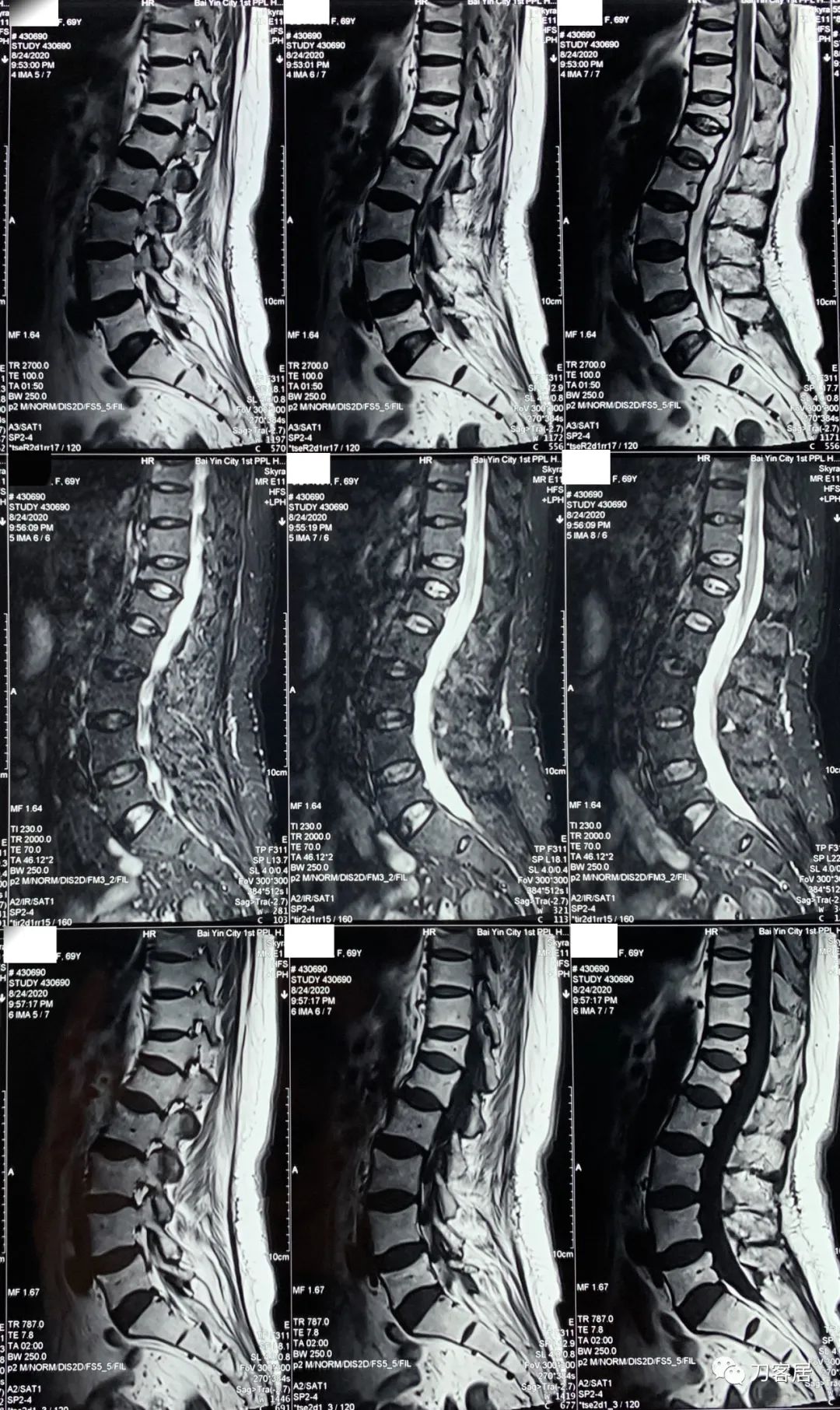 胸椎压缩性骨折病历,脊柱骨质疏松性压缩性骨折