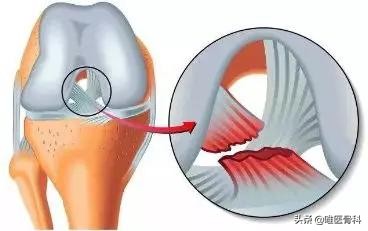 怎么判断交叉韧带损伤,膝关节交叉韧带损伤专家