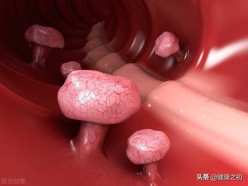 肛门外的小肉疙瘩是什么?专家:不只是痔疮,“元凶”可能是它