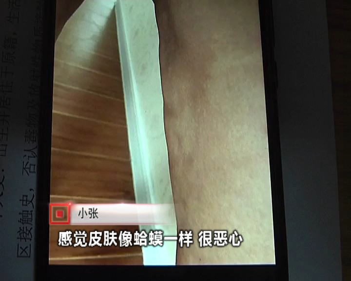 抽脂后身上掉皮,女子抽脂手术后凹凸不平