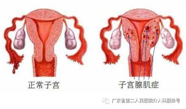 痛经消融手术,痛经微创