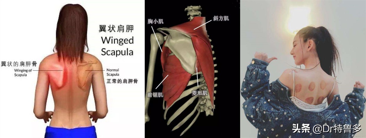 蝴蝶骨不是一种病吗,蝴蝶骨是颈椎病吗