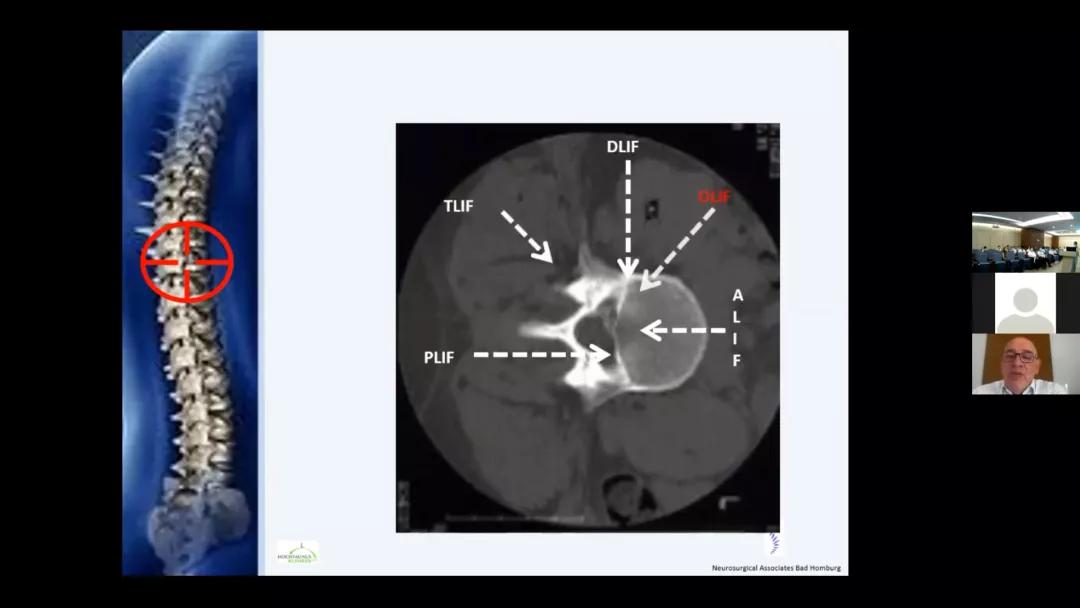 中德万里连线，讨论脊柱疑难病例