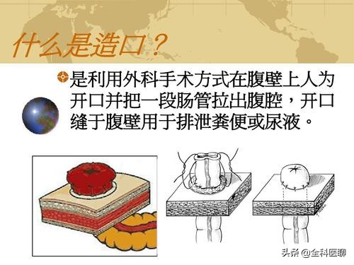肠道造瘘能彻底治愈吗,肠道造瘘的利与弊