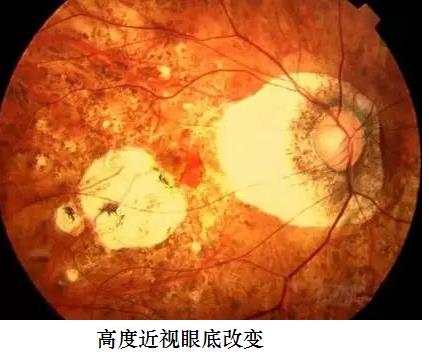 ai眼底照相机检查医院,ai技术落地眼底筛查