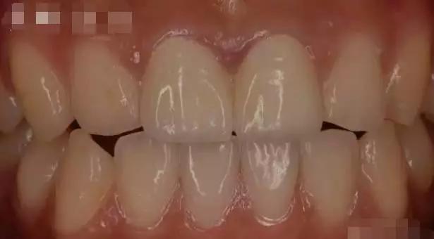 牙医用烤瓷牙冒充全瓷牙,怎么跟牙医说烤瓷牙换全瓷牙