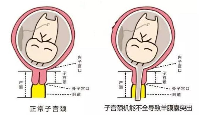 宫颈机能不全患者可以生二胎吗,宫颈机能不全破水流产