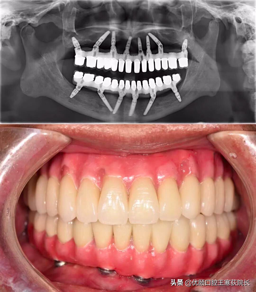 中国人为什么容易掉头发,中国人为什么牙齿龅