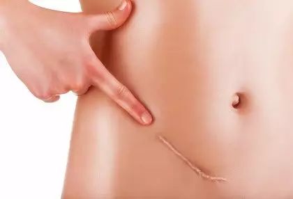 用纹身掩盖自己的伤疤,纹身是为了掩盖伤疤