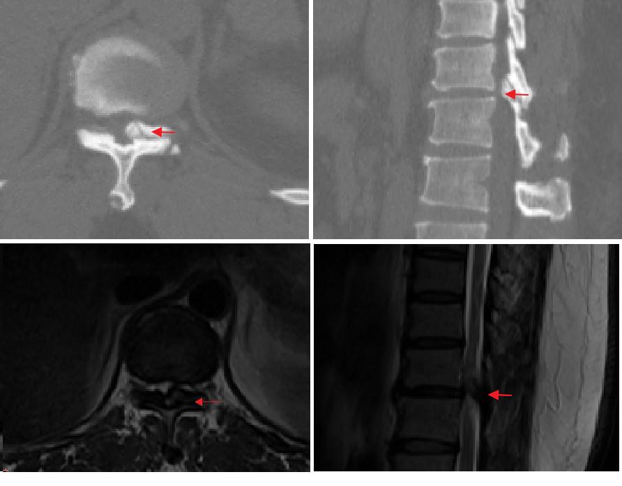 北京积水潭机械臂手术,积水潭机器人微创