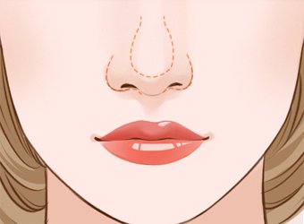 鼻小柱缺陷怎么治,鼻小柱和鼻翼不在一条水平线