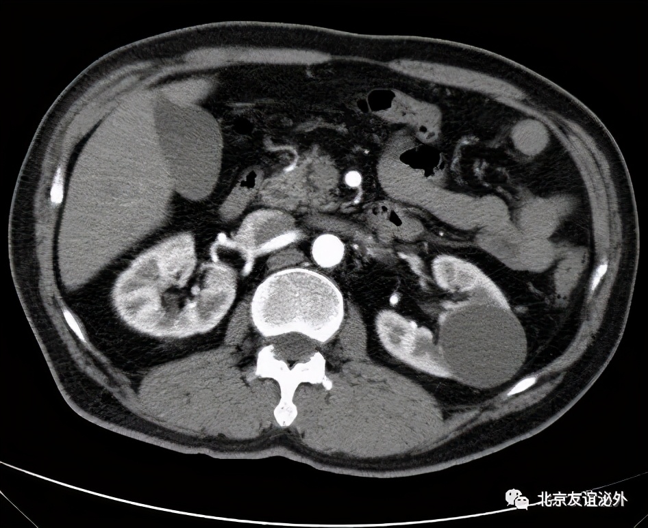 体检发现肾囊肿需不需要做手术,儿童体检发现肾囊肿
