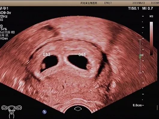 阴部超声检查会影响胎儿健康吗,经阴超声检查会不会容易感染