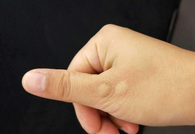 几块钱的罗红霉素管用吗,红霉素软膏多少钱有什么作用