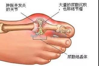 医生没有时间锻炼怎么办,医生不告诉你痛风的秘密