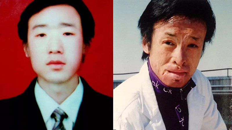 21岁小伙烧伤13人,21岁小伙一人救13人被烧毁容