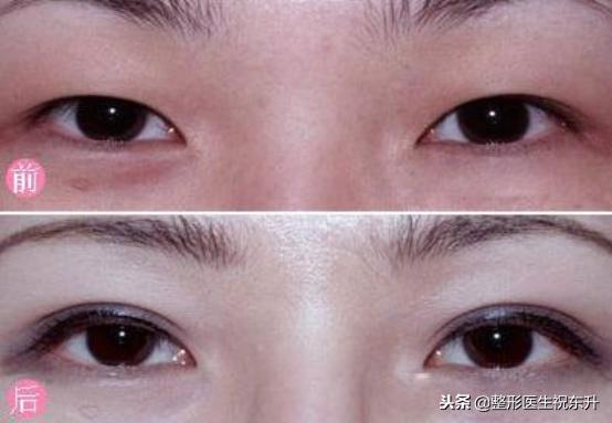 割双眼皮后怎样可以尽快完全恢复,割的双眼皮很不自然要怎么修复呢