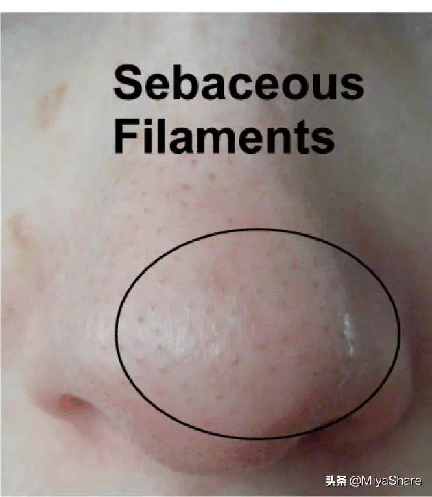 应该怎么正确对待黑头,什么办法才能真正解决黑头