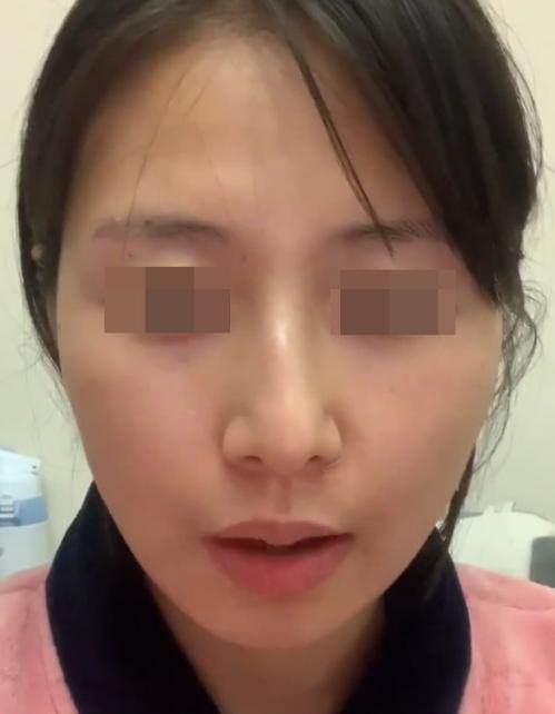 鼻子歪斜矫正手术,鼻子歪斜怎么自我矫正