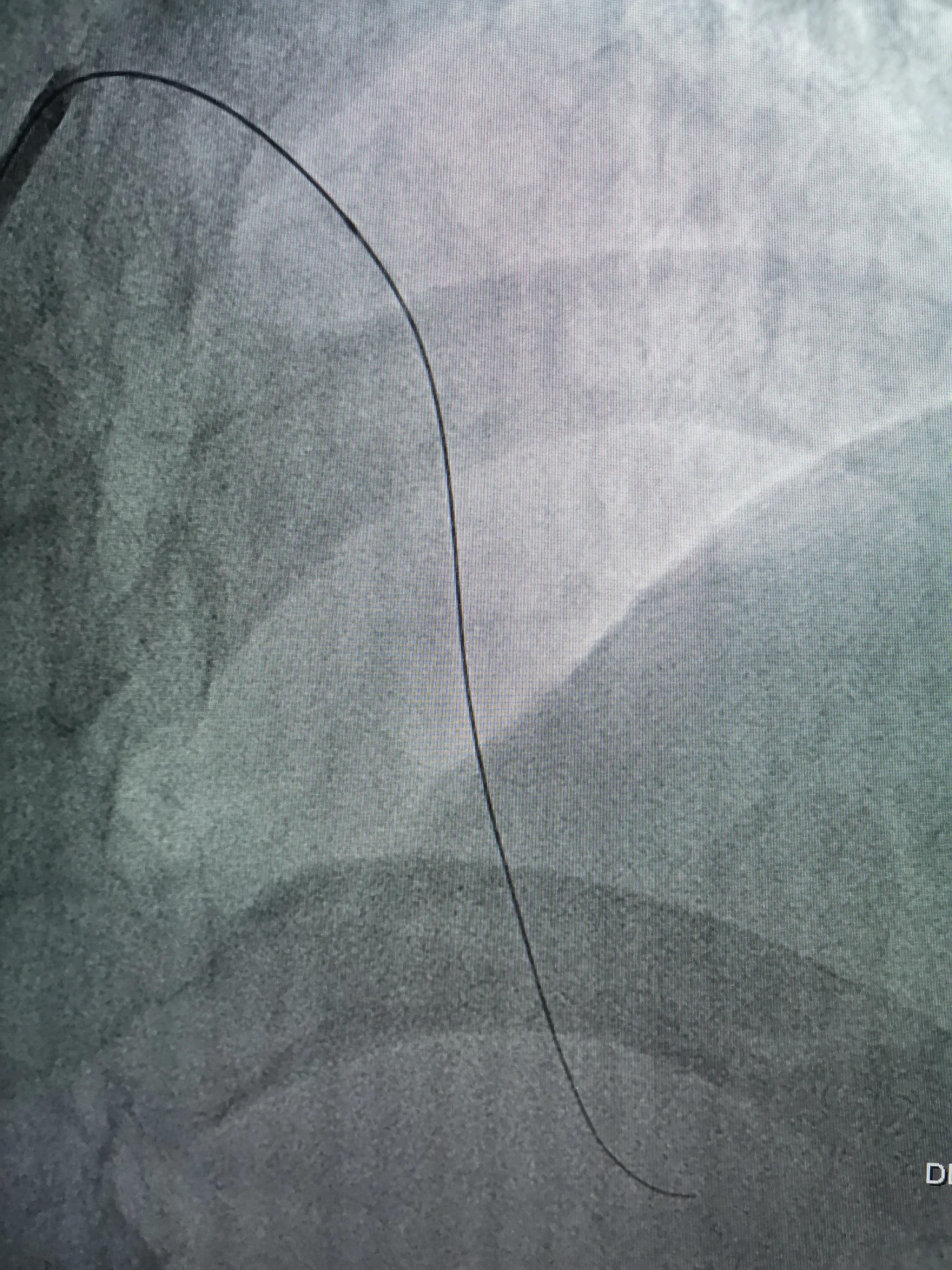 atp术式治疗冠脉分叉病变,冠脉分叉处堵塞能治吗